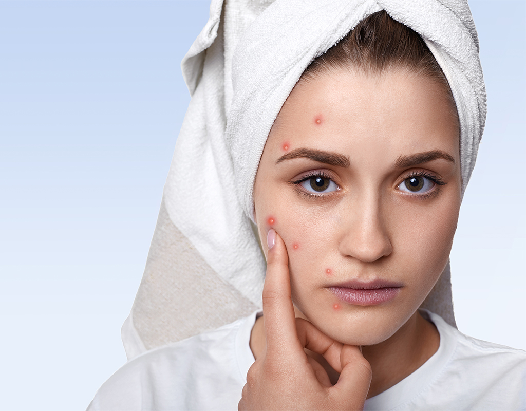 ACNE treatments