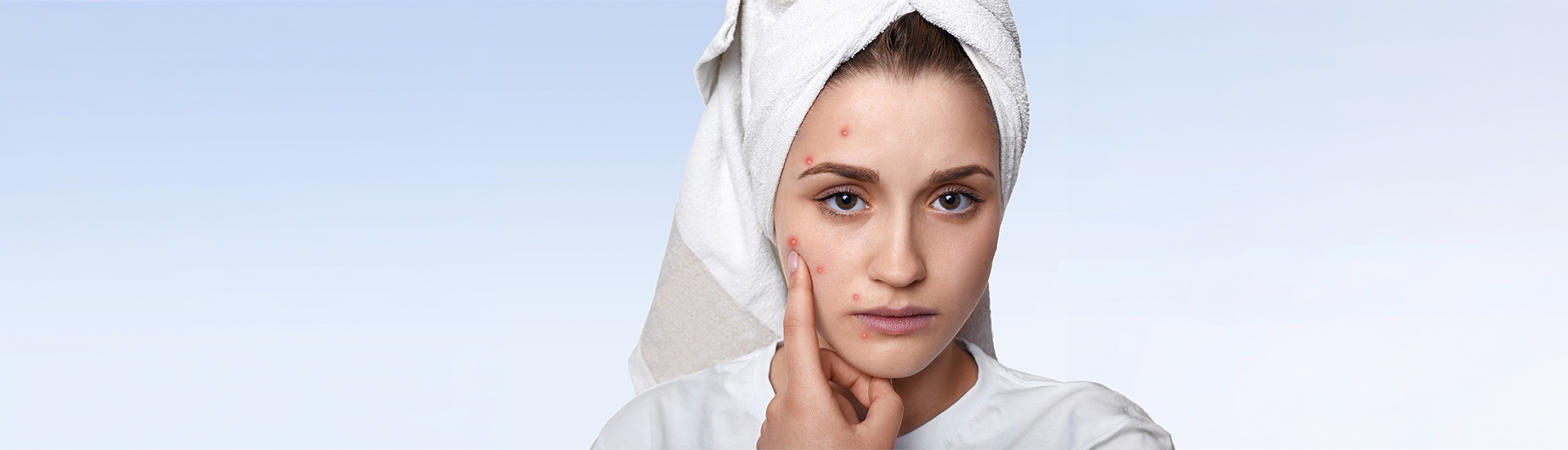 ACNE treatments